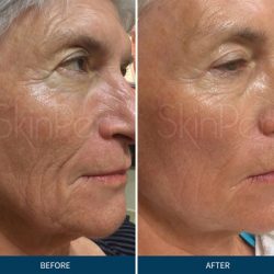 SkinPen Before After 1