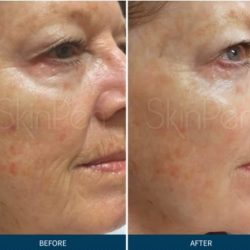 SkinPen Before and After 4 cropped