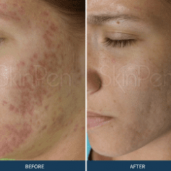 SkinPen Before and After 6